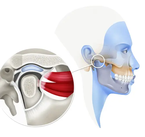 Disfunción temporomandibular (DTM)