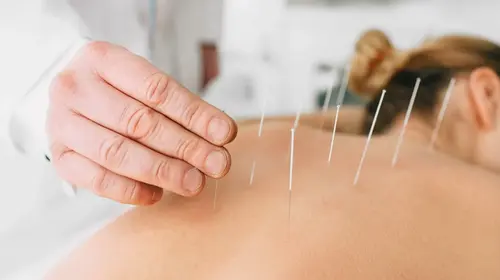 ¿La punción seca es útil para el dolor mandibular?