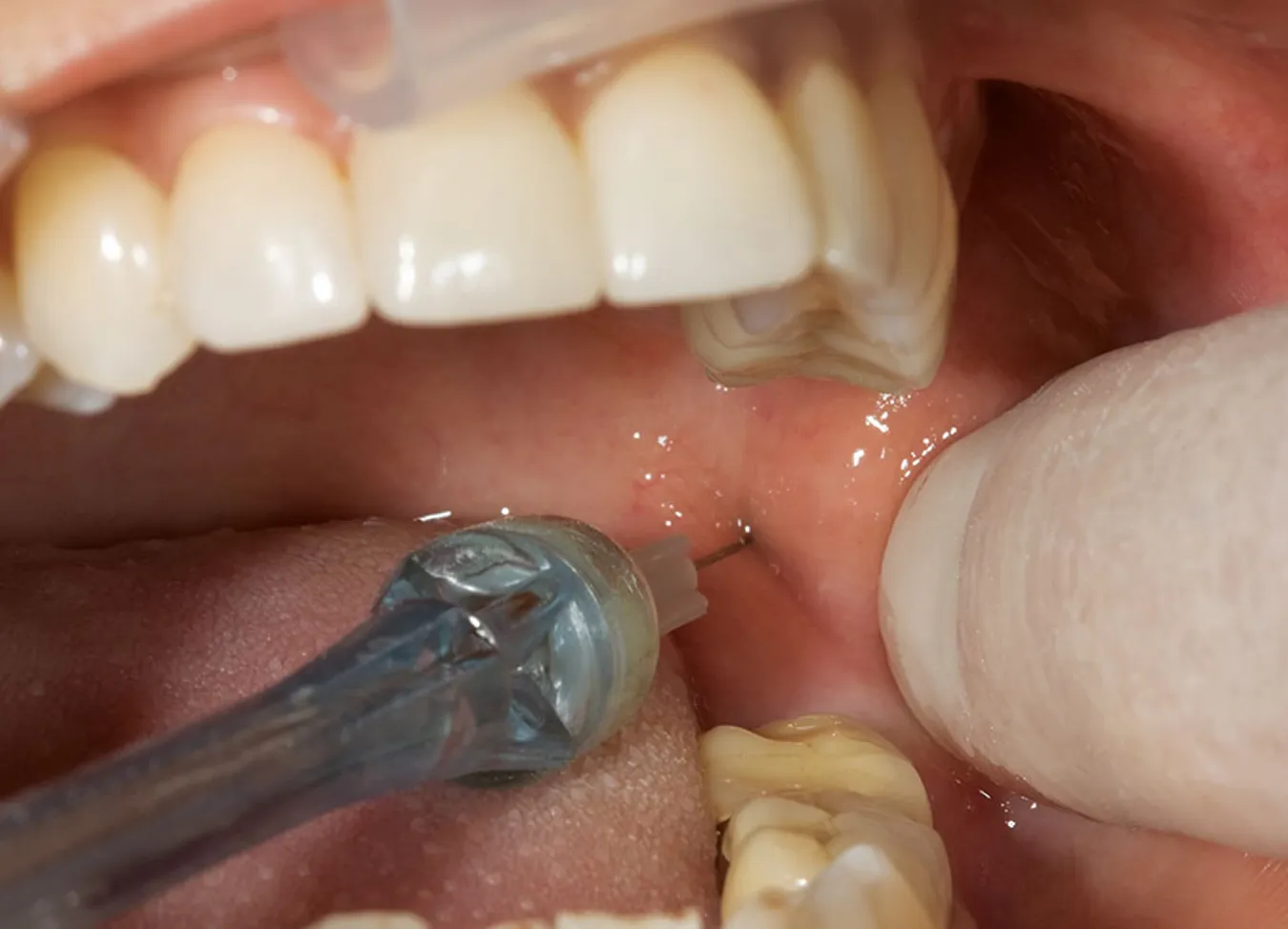 Bloqueo mandibular