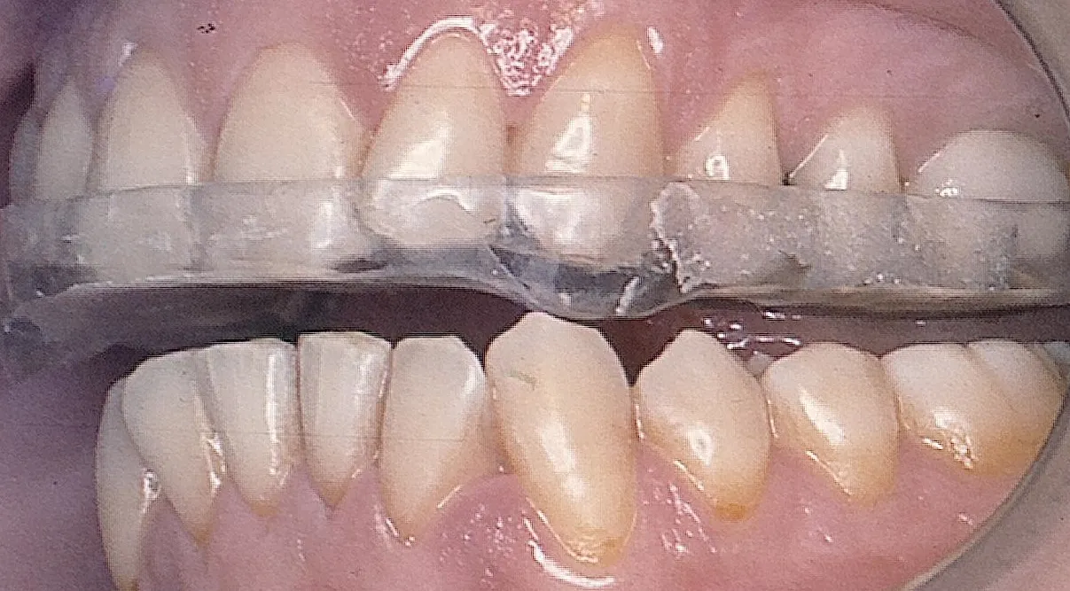 Dolor y tensión mandibular: una consecuencia inevitable