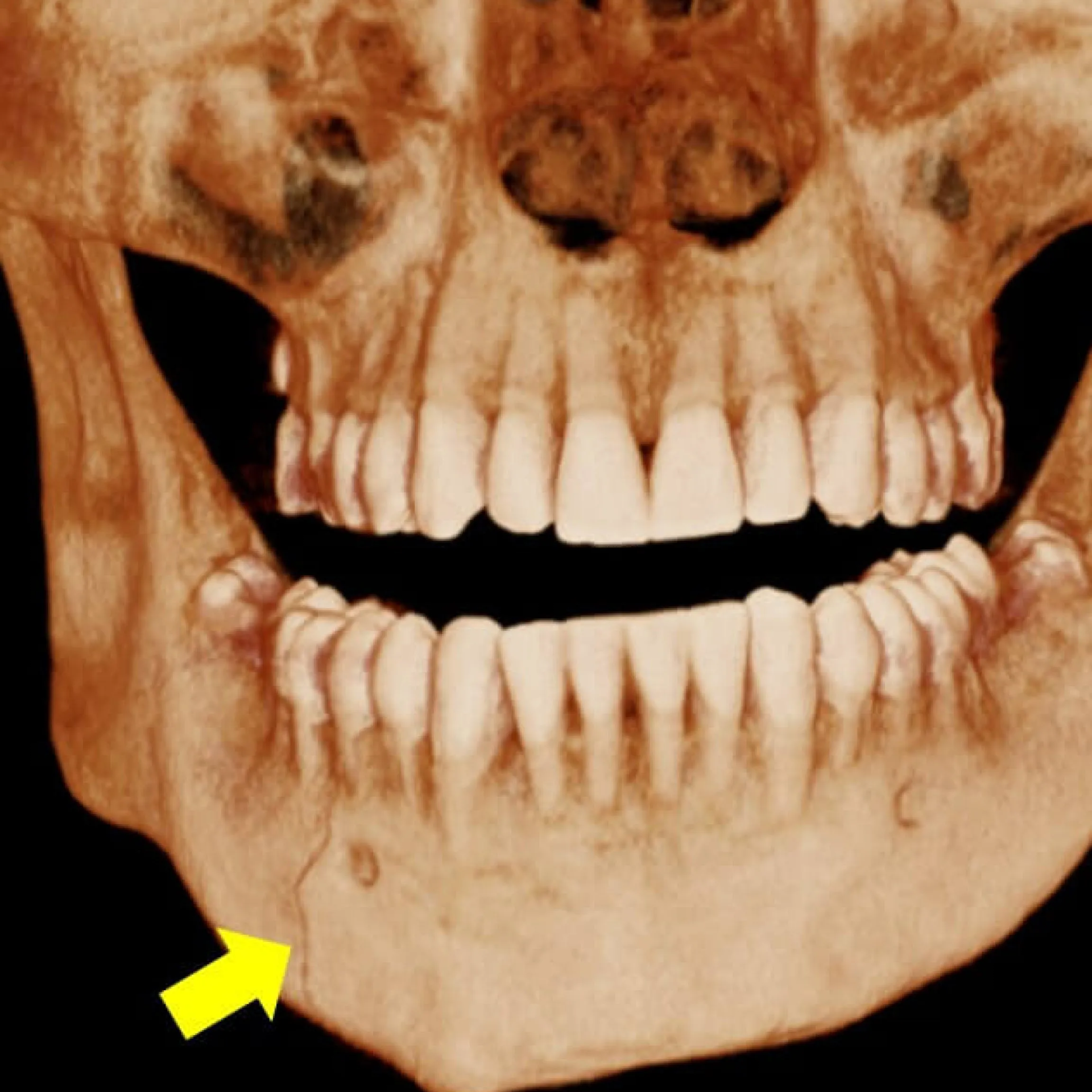 Principales causas de una dislocación mandibular