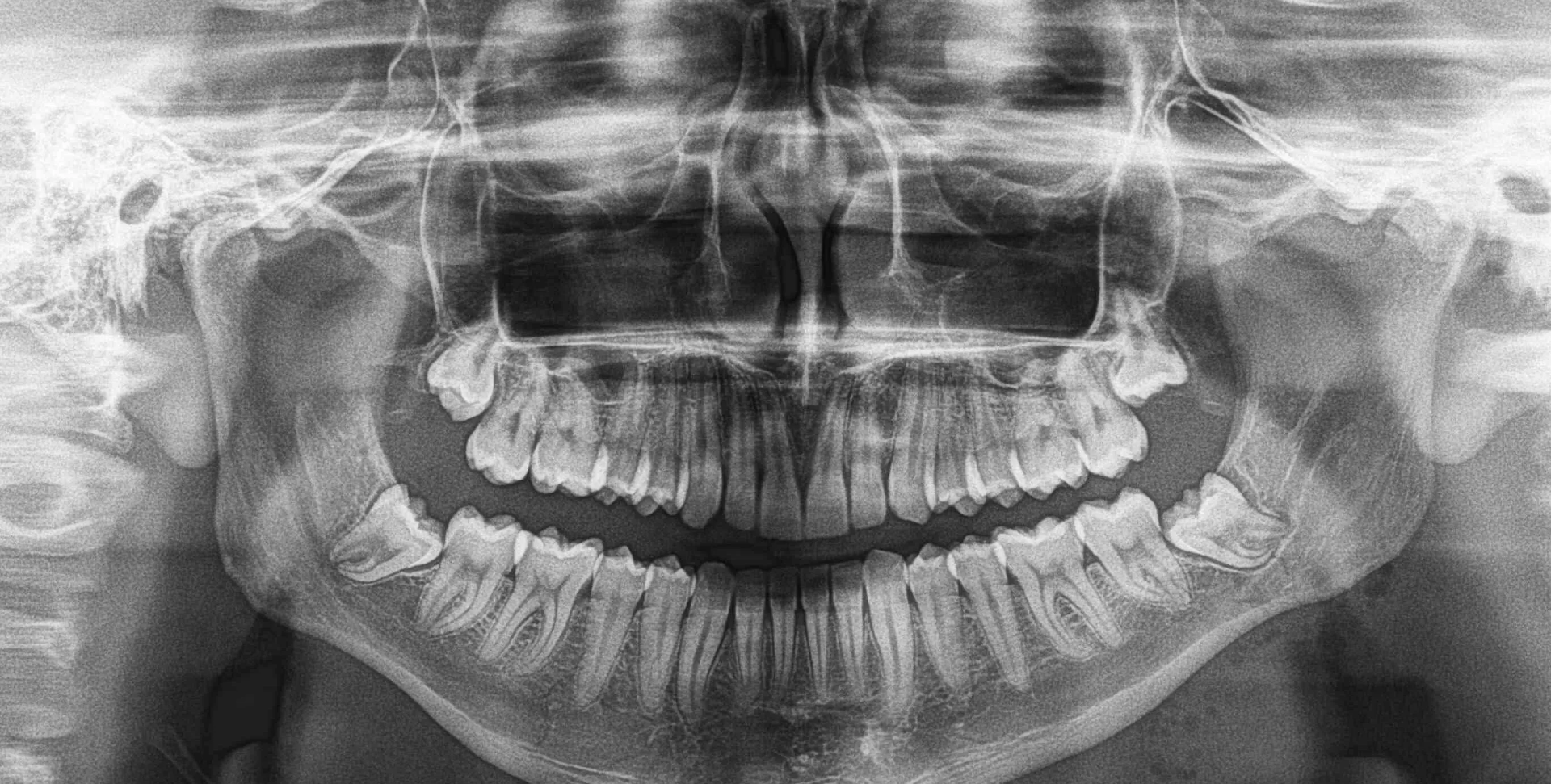 El impacto de la dislocación mandibular en tu vida diaria