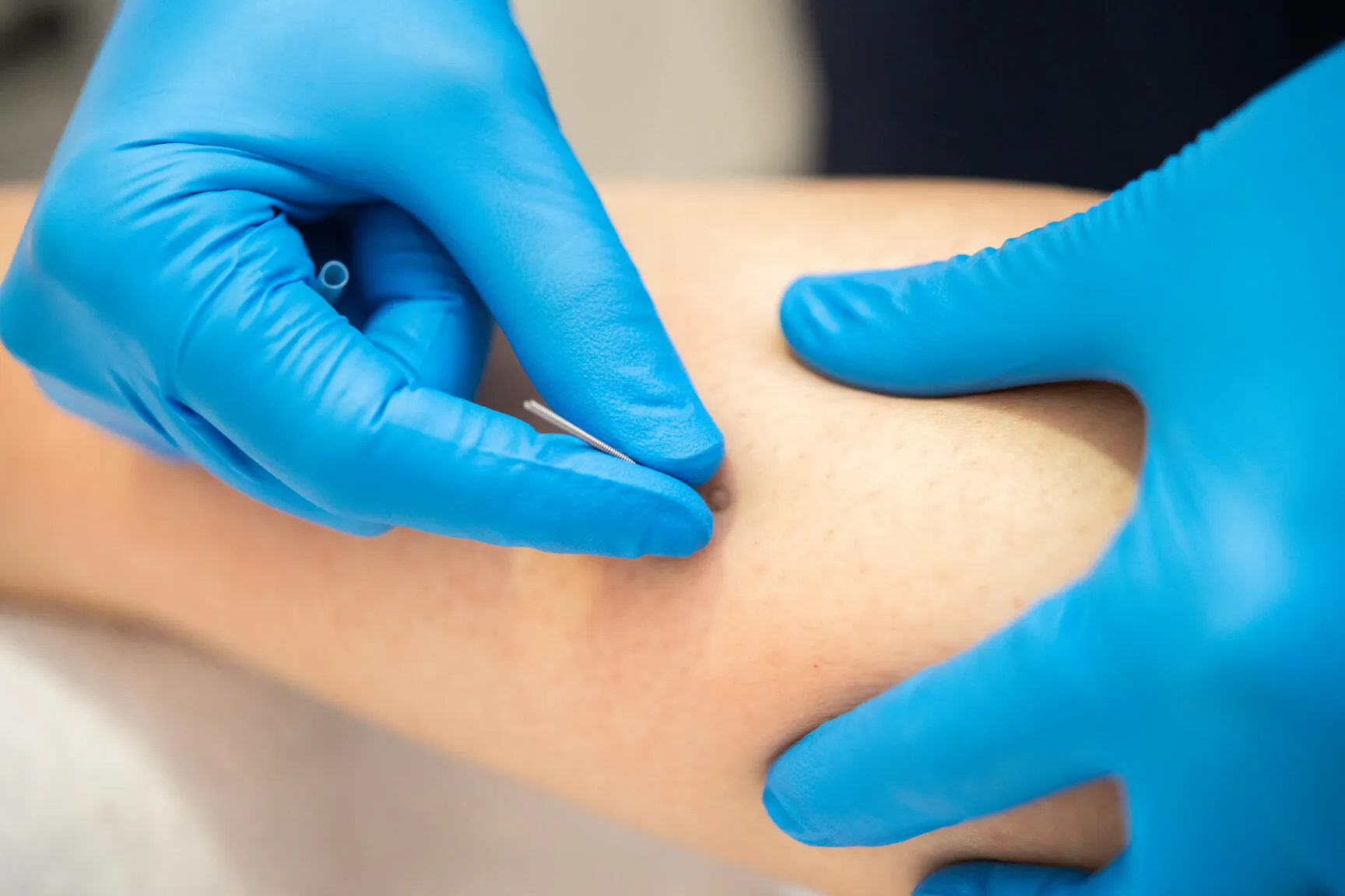 ¿La punción seca es útil para el dolor mandibular?
