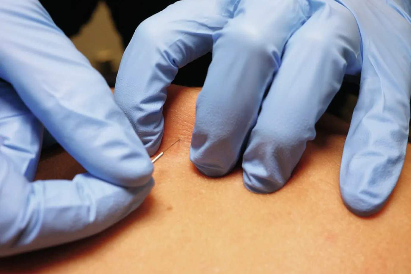Beneficios de la punción seca para el dolor mandibular